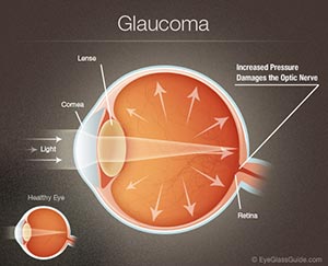 glaucoma-diagram