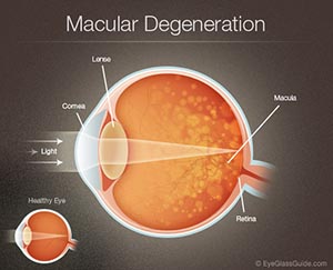macular-degeneration-diagram