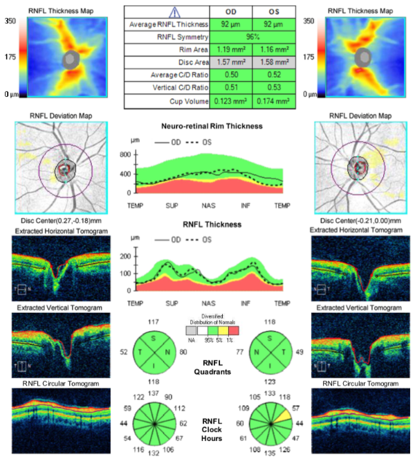 oct optical coherence tomography
