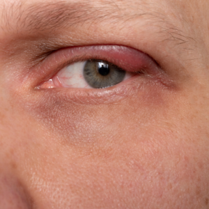 Understanding Blepharitis Causes, Symptoms, and Treatment Options